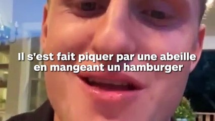 Piqué par une abeille à la langue, elle a triplé de volume
