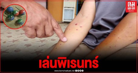อุทาหรณ์ เด็ก 12 ปี จุดประทัดยัดขวดแก้ว คิดว่าชนวนดับย้อนมาเก็บ ตูมสนั่นคามือ