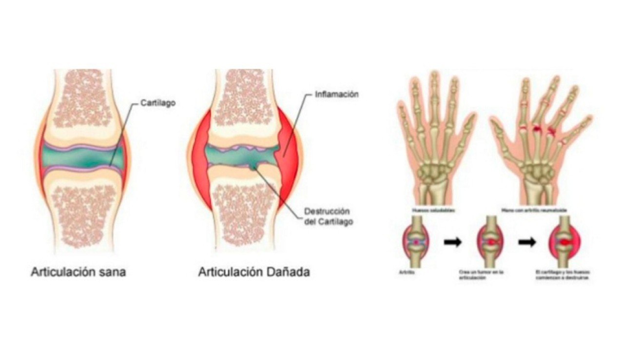 bd-como-aliviar-el-dolor-de-la-artritis-121020