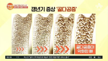 갱년기 여성 "골다공증 위험도가 크다" 충격적인 골밀도 차이!