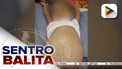 #SentroBalita | Malasakit at Work: Update sa lagay at pagtulong kay Baby Stacy na may biliary atresia