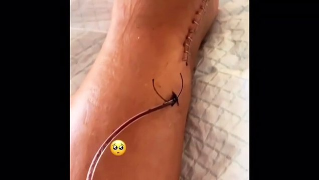 Anabel Pantoja enseña su herida con grapas