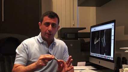 What Are Dental Implants- justSMILE - Ramsgate Beach