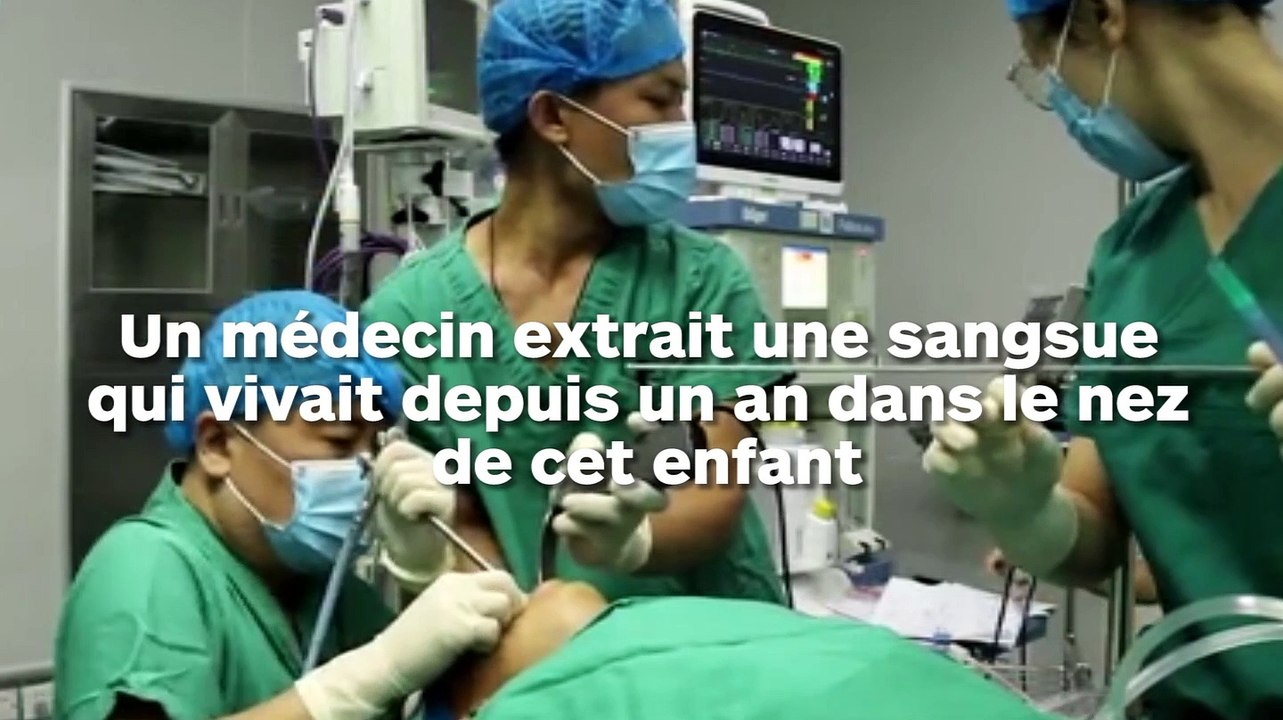 Un médecin retire une sangsue qui vivait dans le nez d'un enfant depuis 1 an