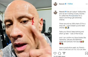 Dwayne 'The Rock' Johnson needed stitches after suffering an eye injury.