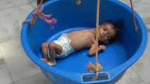منظمات دولية تحذر من ارتفاع معدلات سوء التغذية الحاد بين أطفال اليمن