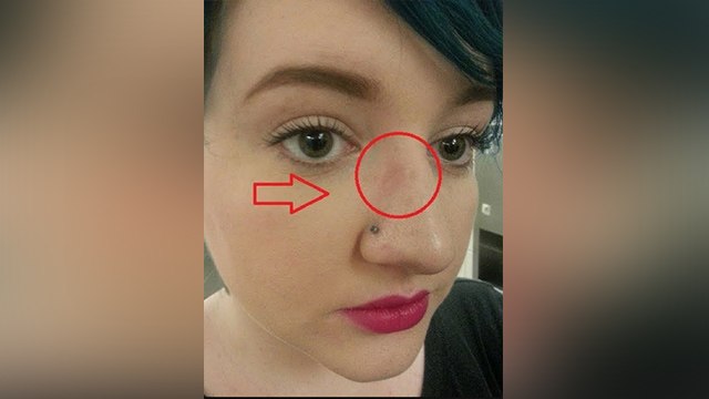 चश्मा पहनने से पड़ गए हैं निशान,तो इन आसान घरेलू नुस्खे दूर करें ये निशान । Boldsky