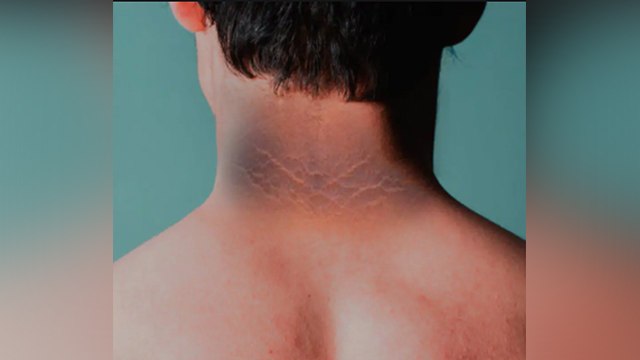 पीठ पर पड़े हैं काले रंग निशान तो करें ये काम, गायब हो जाएंगे सारे निशान | Boldsky