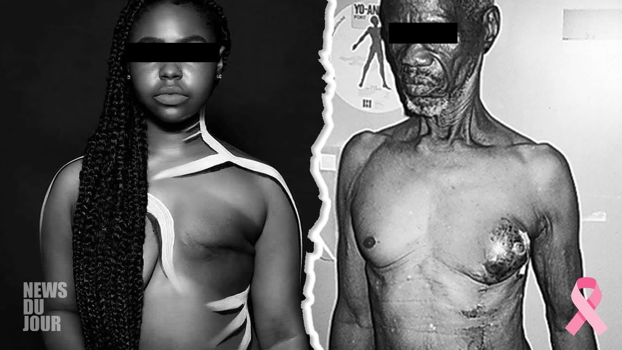 LE CANCER DU SEIN, UNE MALADIE QUI TOUCHE AUSSI LES HOMMES