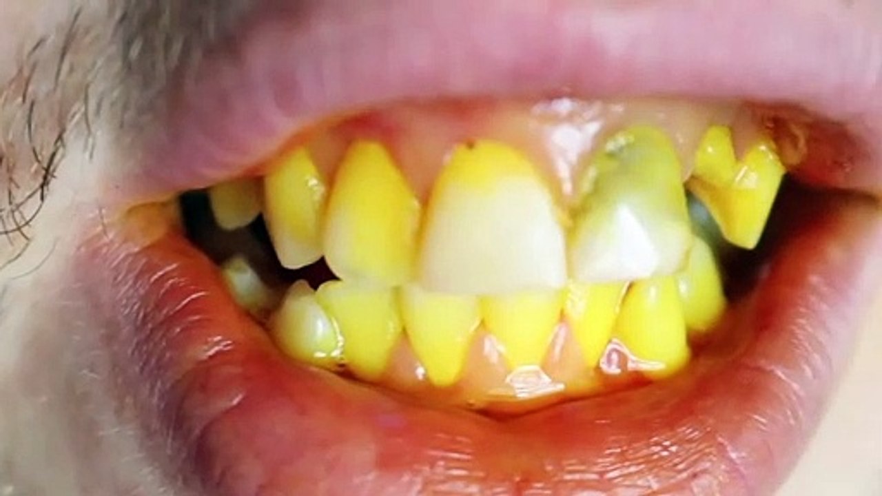 How To Whiten Your Teeth