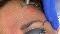 Minimize acne scarring with laser resurfacing