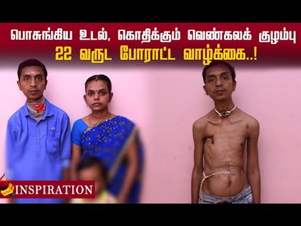 பொசுங்கிய உடல், 22 வருட போராட்ட வாழ்க்கை..! கண்ணீர்க் கதை!#Inspiration