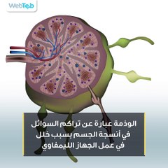 ما هي الإصابة بالوذمة؟