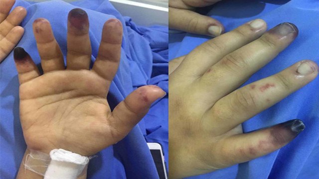 Coronavirus के बाद फैली बीमारी Gangrene Symptoms, Reasons | गैंगरीन बीमारी के कारण और लक्षण |Boldsky