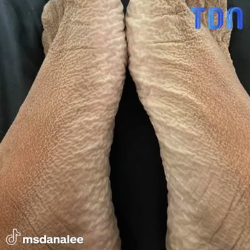 Elle reste 16 heures dans un bain, ses pieds sont transformés...