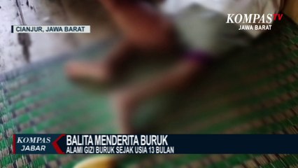 Hai Pemerintah! Ini Ada Balita di Cianjur Menderita Gizi Buruk