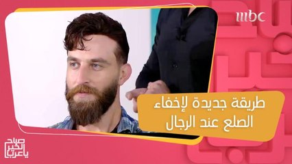للرجال الذين يعانون من الصلع.. حل سريع يمنحك شعر طبيعي ولوك شبابي!