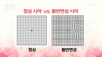 노인성 안질환에 대해서....