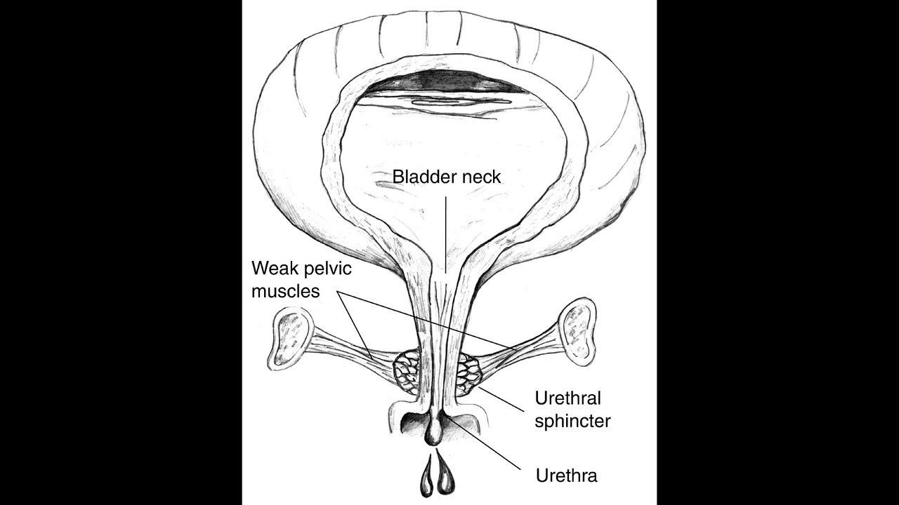 178Hz Bladder sphincter