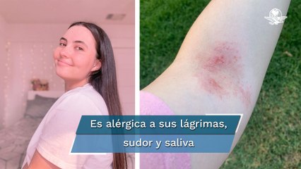 Tessa, la joven que es alérgica al agua; incluso sus lágrimas la lastiman