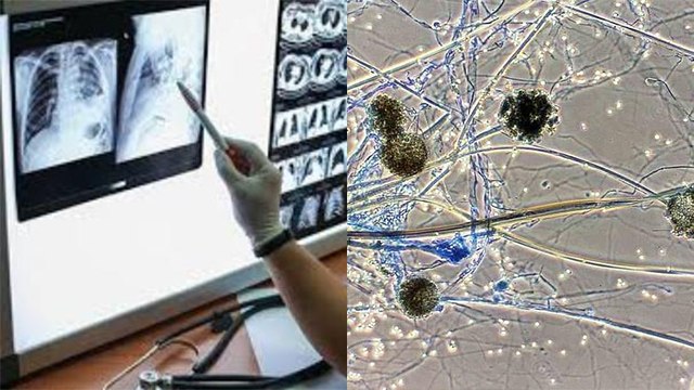 सिर्फ India में ही क्यों फैल रहा Black Fungus, Mucormycosis पर बड़ा खुलासा | Boldsky