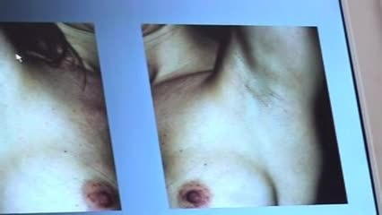 Les différentes techniques pour placer la prothèse mammaire