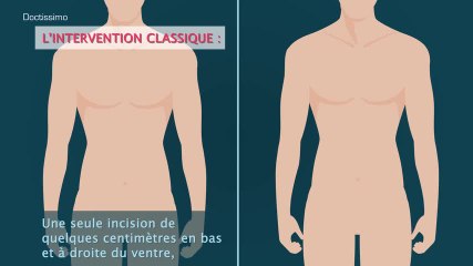 Reconnaître les signes de l’appendicite