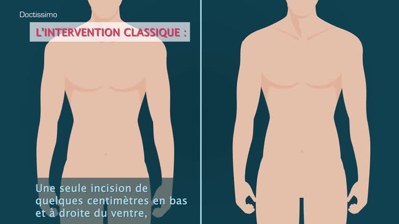 Reconnaître les signes de l’appendicite