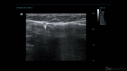 Varices : le traitement par sclérothérapie