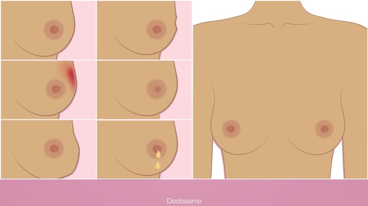 Comment pratiquer l’auto-palpation des seins