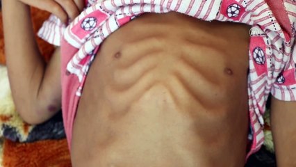 SANA - Yemen'de akut yetersiz beslenme sorunu çocukların hayatını karartıyor