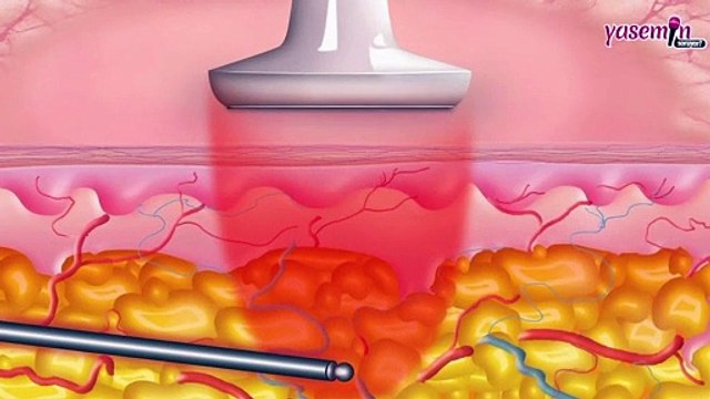 Kimler Liposuction yapabilir? Liposuction Operasyonu nedir ve ne işe yarar?