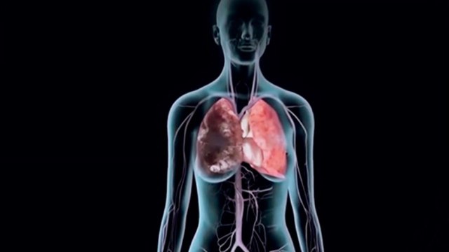 bd-trombosis-venosa-profunda-010621