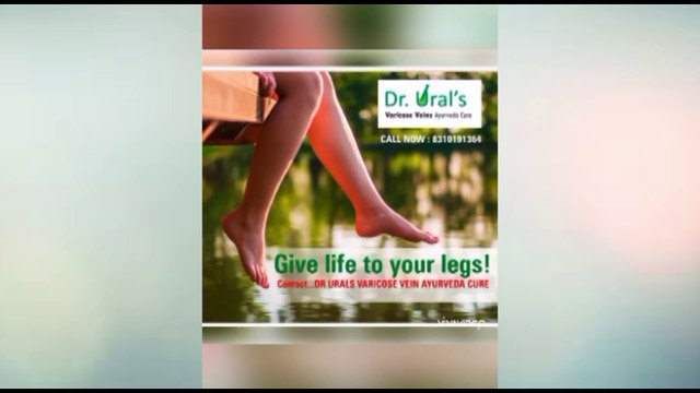 Dr Ural Varicose Veins ayurveda care now in Mangalore