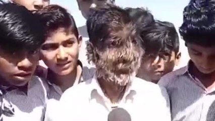 Conoce a Lalit Patidar, el niño que padece el síndrome del ‘hombre lobo’