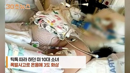[30초뉴스] 틱톡 따라 하던 10대 중화상…알코올 그림에 불붙였다 폭발