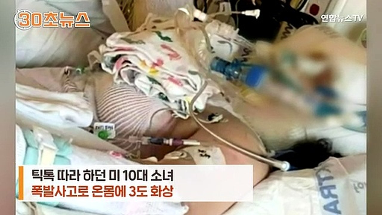 [30초뉴스] 틱톡 따라 하던 10대 중화상…알코올 그림에 불붙였다 폭발