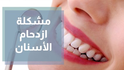 ازدحام الأسنان مشكلة صحية تداركها قبل أن تتفاقم