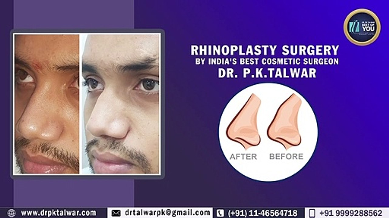 Affordable / Lowest Cost Rhinoplasty (Nose Job) in India, Delhi by