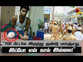 காலினை இழந்த  21 வயது இளைஞனின் எதிர்காலம் என்ன ?