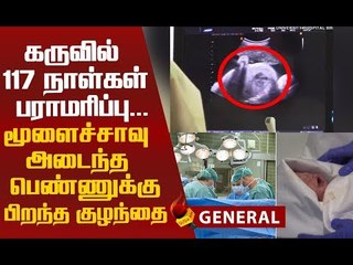 மூளைச்சாவு அடைந்த தாய்...கருவிலேயே சிசு..! #OMG