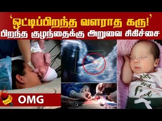 Twins-தான்..ஆனால் ஒன்று உயிரற்ற கரு..! #Shocking #Baby