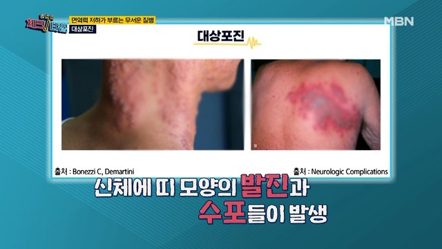 면역력 저하가 부르는 무서운 질병! [대상포진&암]