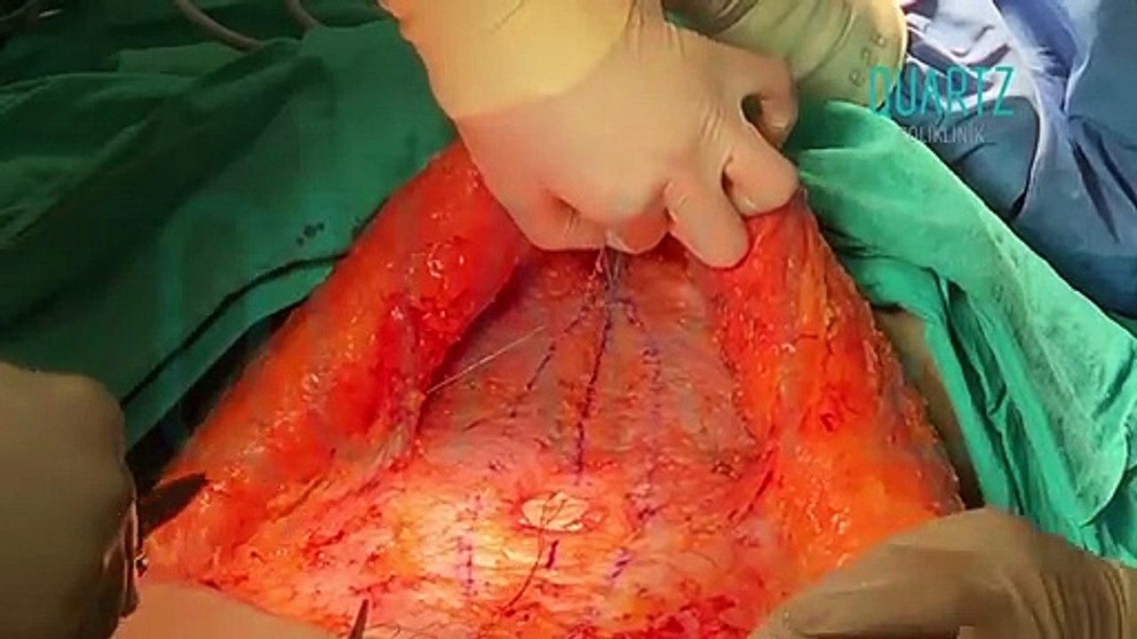 Karın Germe Ameliyatı Nasıl Yapılır? | Karın Germe Ameliyatı Hakkında Her Şey