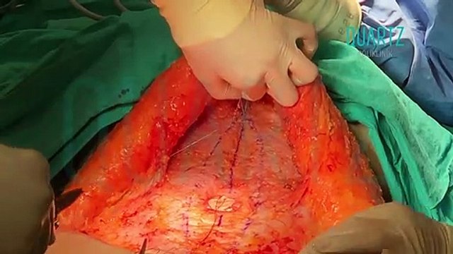 Karın Germe Ameliyatı Nasıl Yapılır? | Karın Germe Ameliyatı Hakkında Her Şey