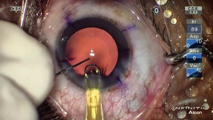 Toric IQ IOL - The Eye Foundation