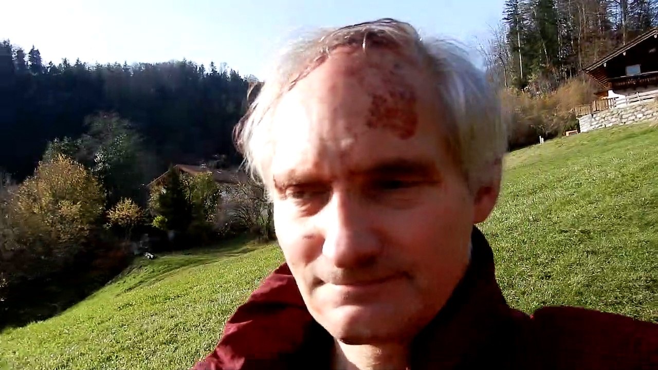 Peter Krug with a laceration