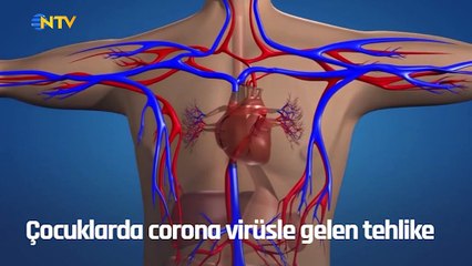 Çocuklarda corona virüsle gelen tehlike- MIS-C Sendromu