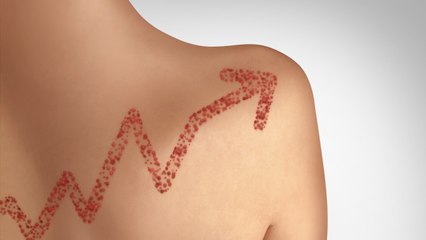 Measles Never Really Went Away, And It Killed 200,000 in 2019