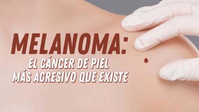 Melanoma el cancer en la piel mas agresivo que existe